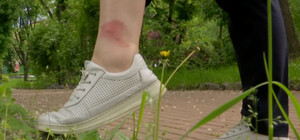Многие жители Киева стали жертвой атаки мошки: что делать после укусов