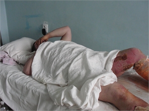 39-летний Андрей ценой здоровья спас многих людей, а теперь, когда смотрит на свои ноги, не может сдержать слез. Фото Александра Бочкарева