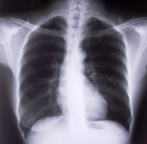 Позаботьтесь о своем здоровье, проверьтесь на туберкулез. Фото с сайта www.sxc.hu.