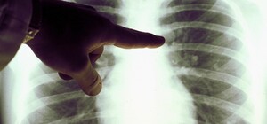 Больным с пневмонией в Одессе делают тесты на коронавирус: врачи к ним ходят без защиты