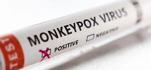 В Україні зафіксували перший випадок захворювання на мавпячу віспу