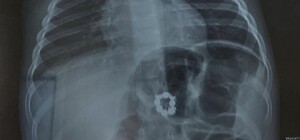 Врачи Охматдета спасли мальчика, который проглотил магниты и месяц жил с ними