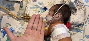 В Одессе прооперировали двух грудных детей с врожденными пороками сердца