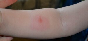 На Дніпропетровщині зафіксувати 8 випадків небезпечної хвороби: як уберегтися