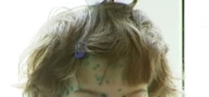 В столице разбушевалась ветрянка: более шести тысяч заболевших