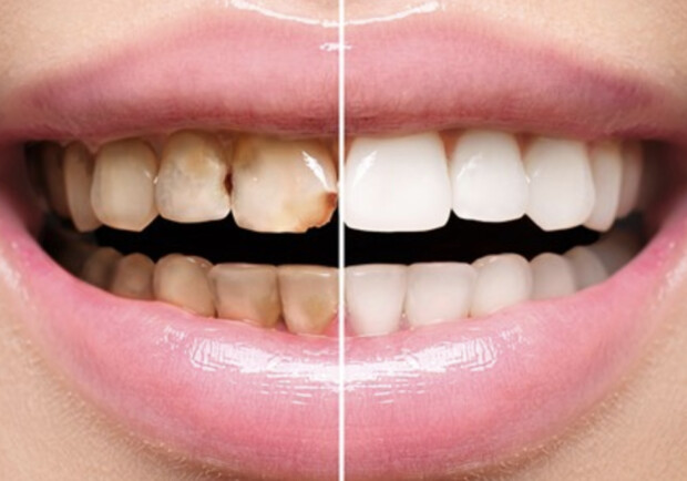 В каких случаях показана реставрация зубов и как она проводится сегодня: гайд по процедуре - фото