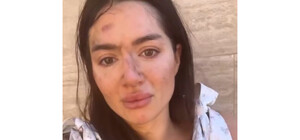 Упала со склона, убегая от извращенца: в Одессе девушку пытался изнасиловать незнакомец