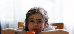 Луганские медики рассказали, как  распознать ветряную оспу