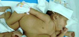 Судьбу сиамских близнецов, которые родились на Донбассе, решит медкомиссия