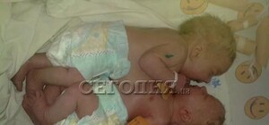Мама сиамских близнецов из Краматорска родила в 40 лет. И ни разу не обследовалась