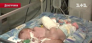 Сиамские близнецы умерли в донецкой больнице