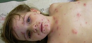 В школах Донецкой области фиксируют заражения ветрянкой