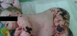 В Донецке спасают малышку с жуткими инфекционными ожогами 