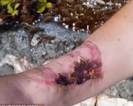 В Севастополе лошадь в парке откусила женщине часть руки