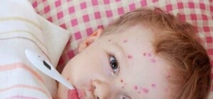 Будьте обережні: у Тернополі оголосили про спалах кору