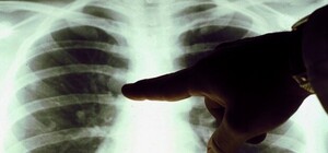 Где в Киеве можно бесплатно сделать флюорографию в мае: адреса