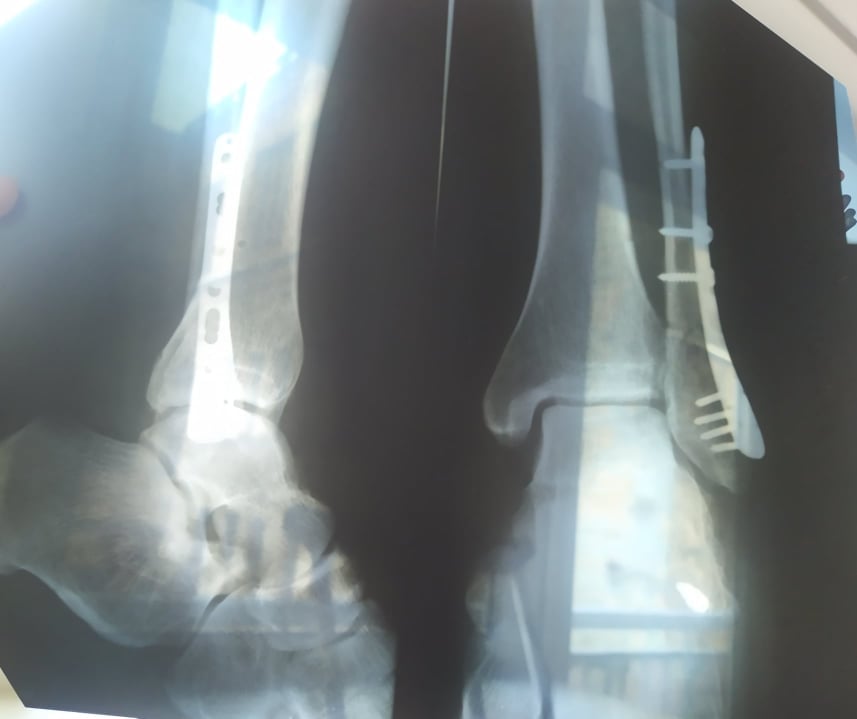 Рентгеновский снимок Ксении. Фото: Facebook Irbis Yotke