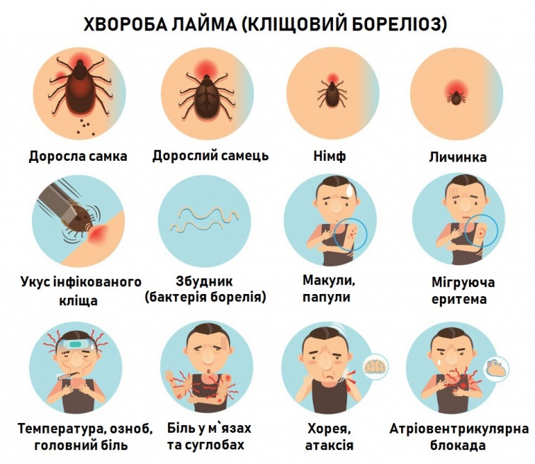 Признаки болезни Лайма (клещевой иксодовый боррелиоз, лайм-боррелиоз)